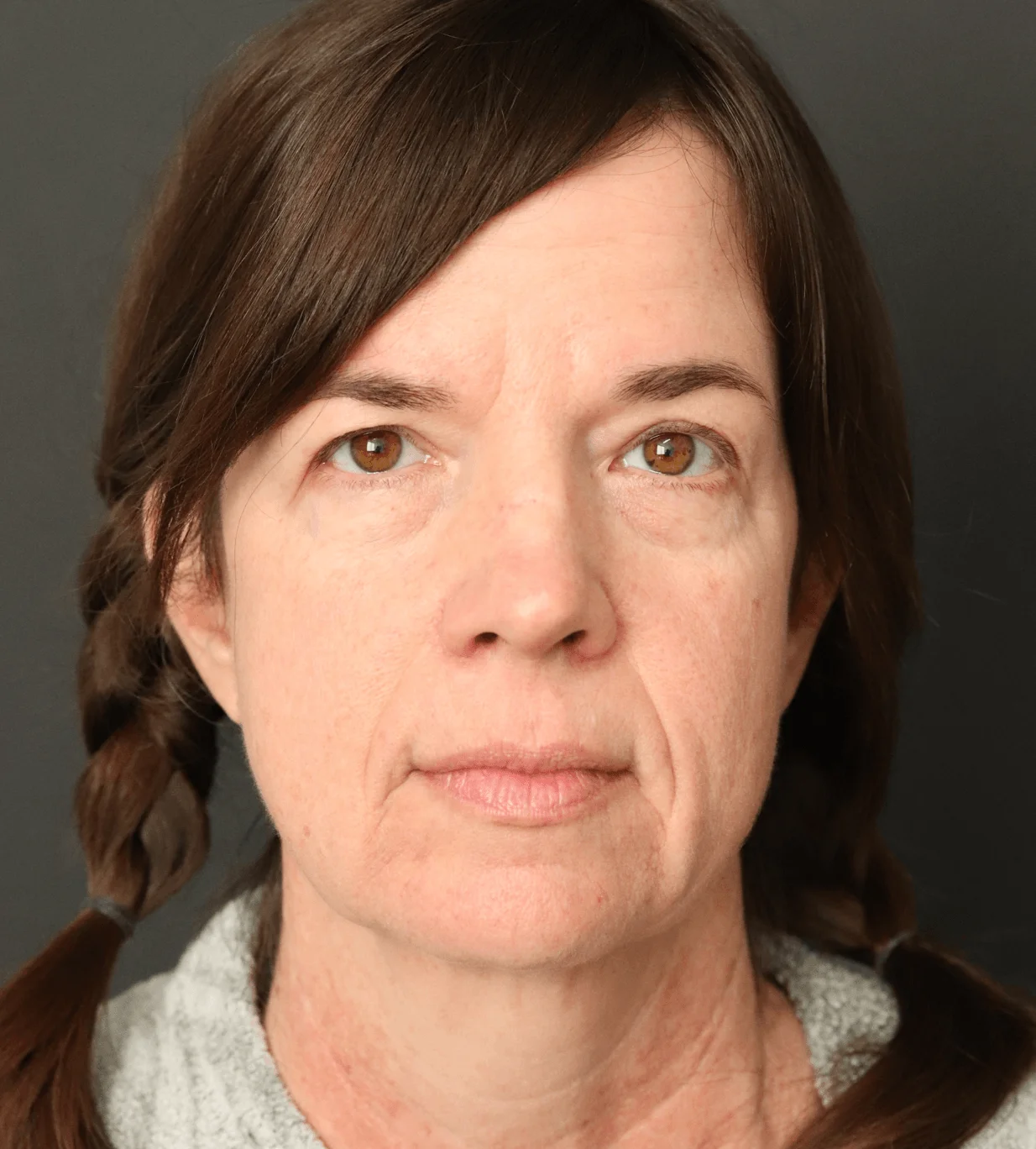 Deep plane facelift before — Austin TX patient frontal