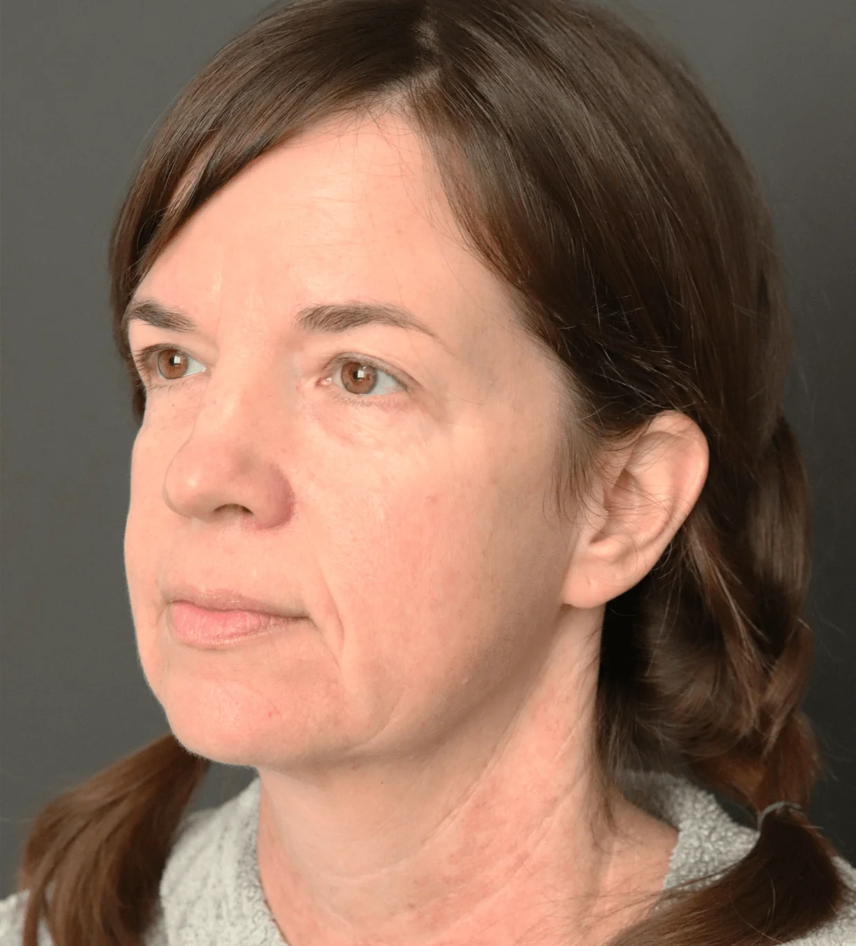 Deep plane facelift before — case 2, Austin TX