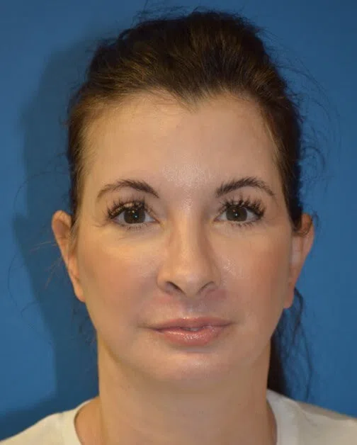 Deep plane facelift after patient 2