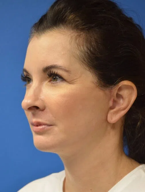 Deep plane face and neck lift — after, oblique view