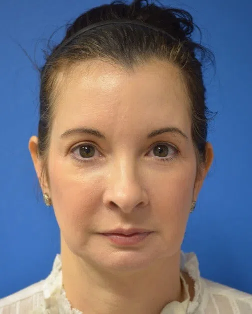 Deep plane facelift before patient 2