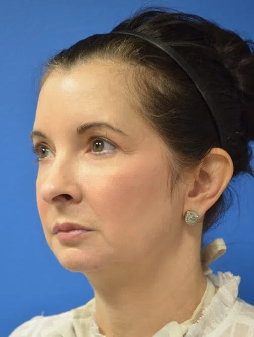 Deep plane face and neck lift — before, oblique view