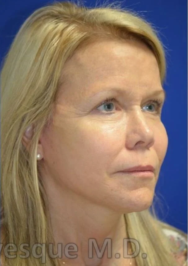 Deep plane facelift after — case 4, Austin TX