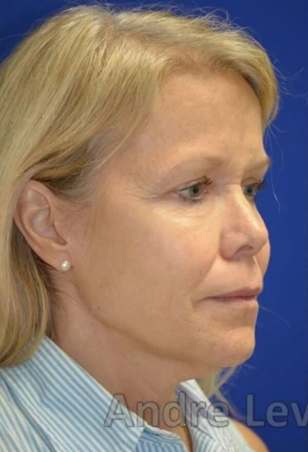 Deep plane facelift before — case 4, Austin TX