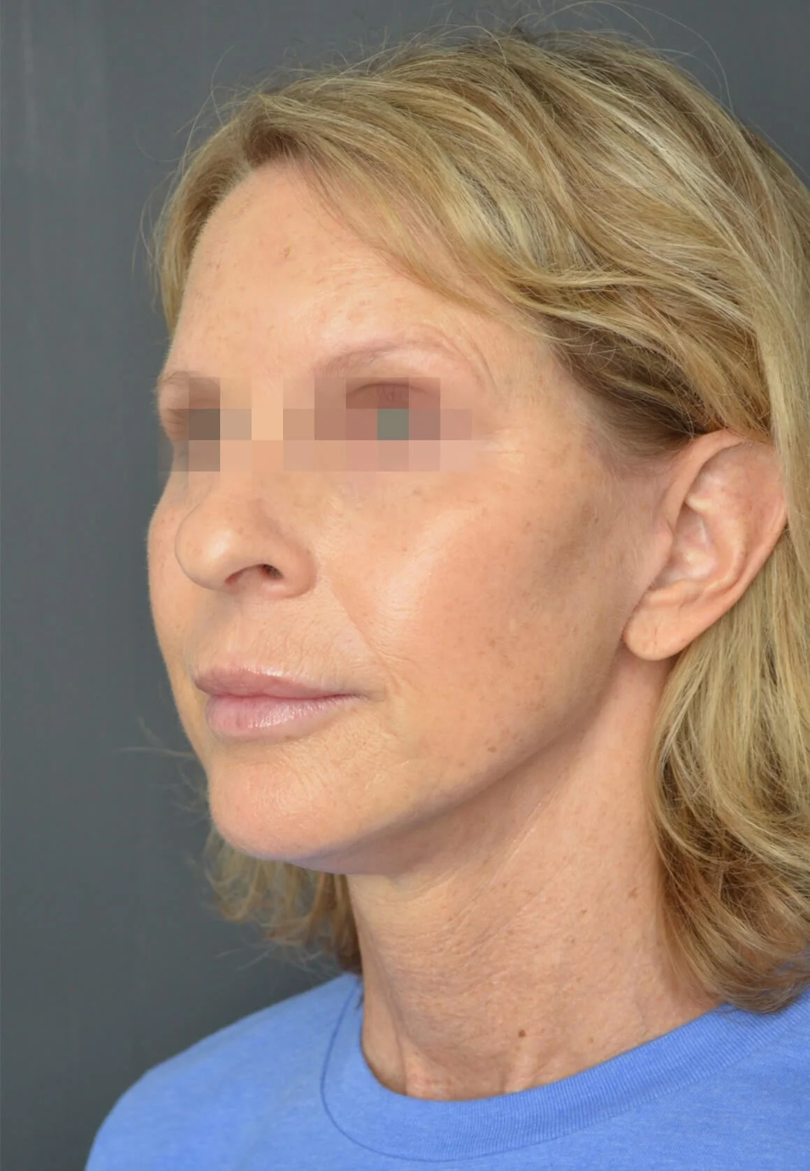 Deep plane facelift after — case 5, Austin TX