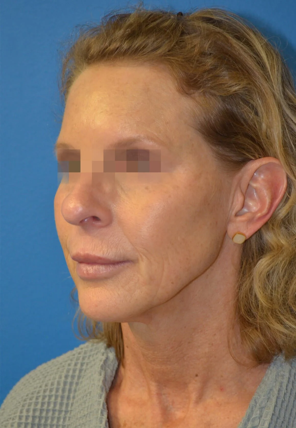 Deep plane facelift before — case 5, Austin TX