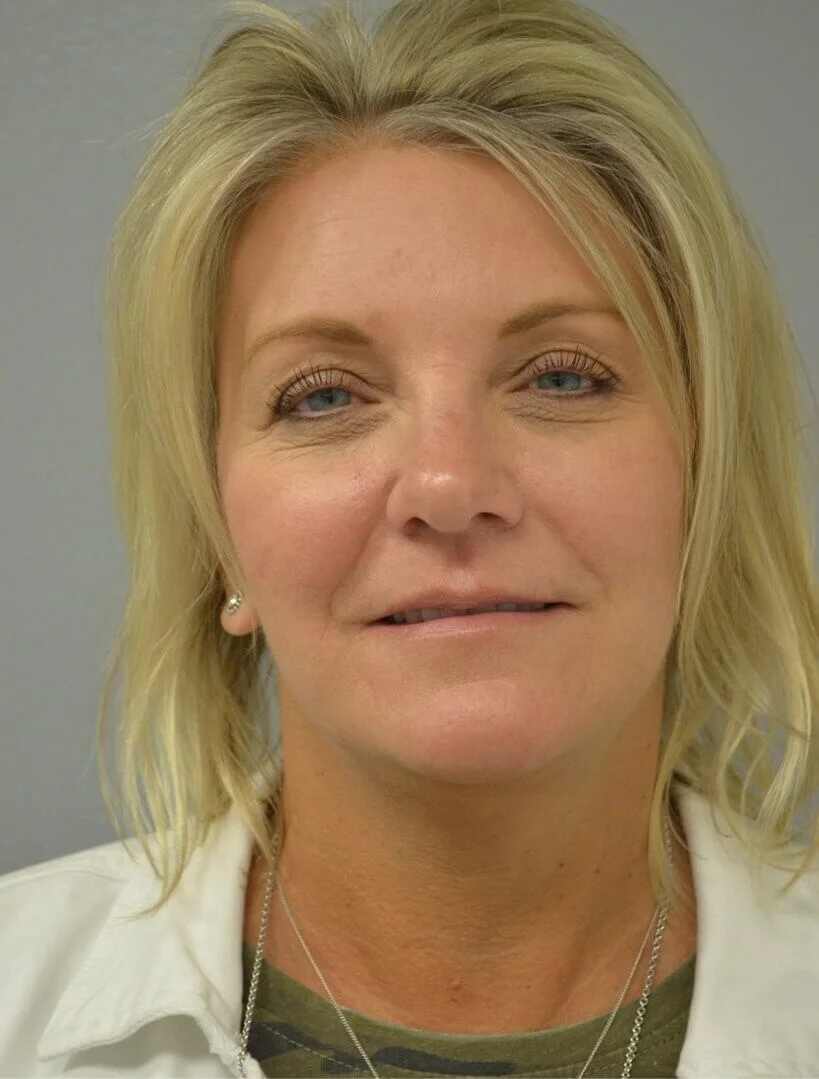 Facelift after — Austin TX patient frontal