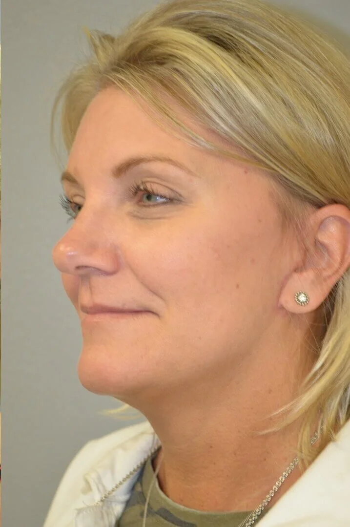 Deep plane facelift after — case 6, Austin TX