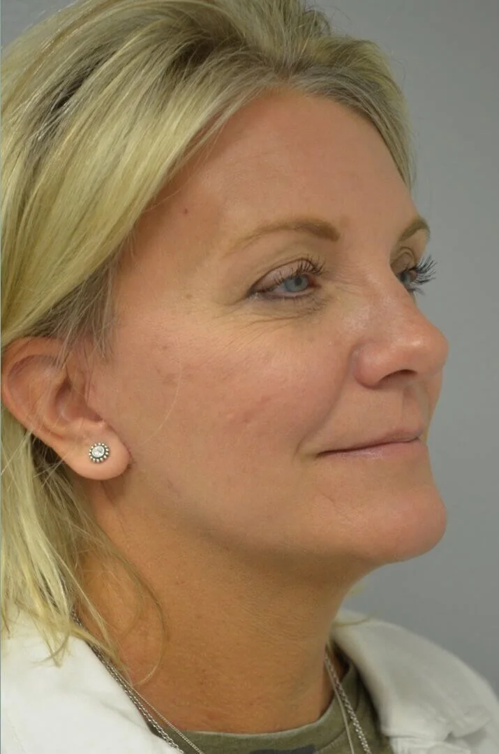 Deep plane facelift after — Austin TX patient