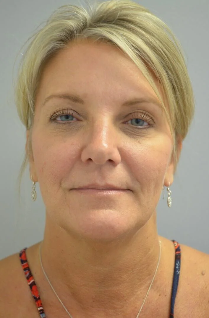 Facelift before — Austin TX patient frontal