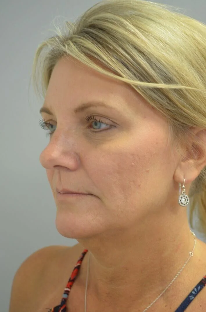 Deep plane facelift before — case 6, Austin TX