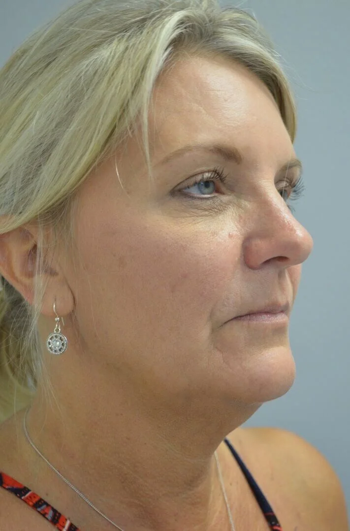 Deep plane facelift before — Austin TX patient