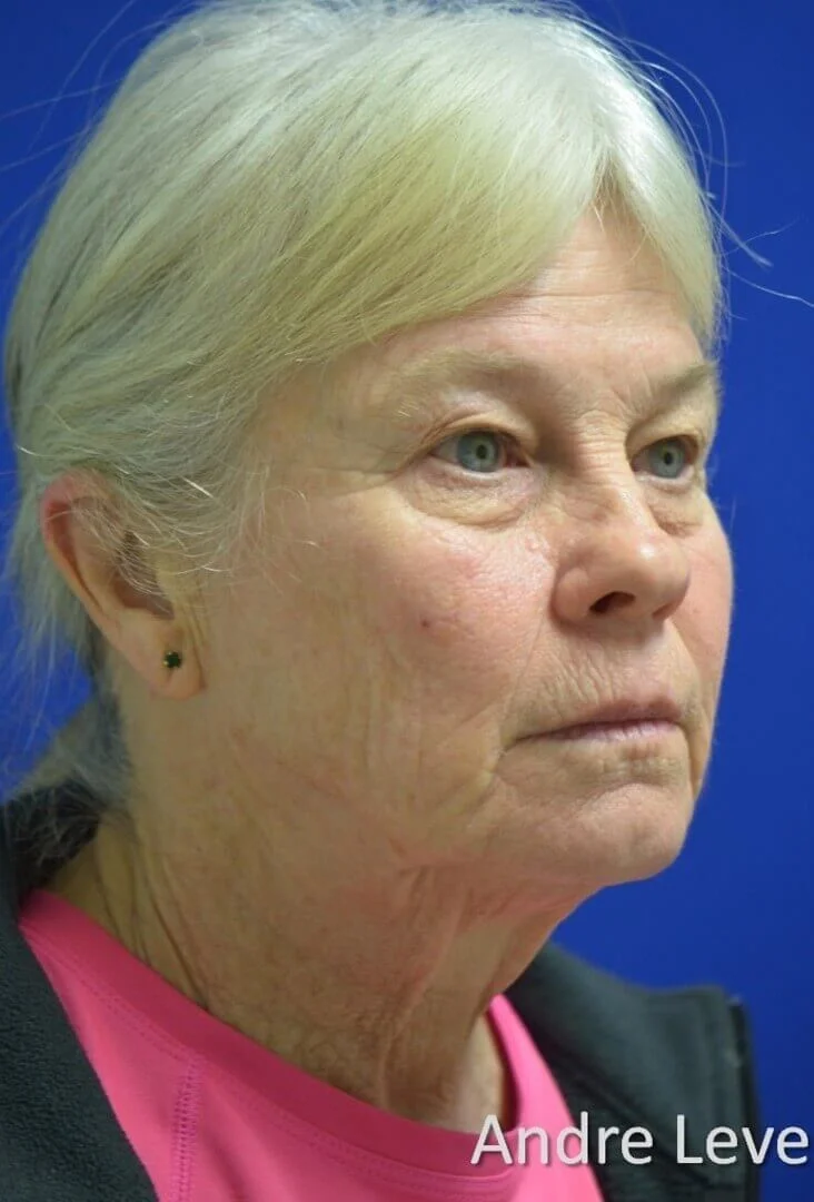 Deep plane facelift before — case 7, Austin TX