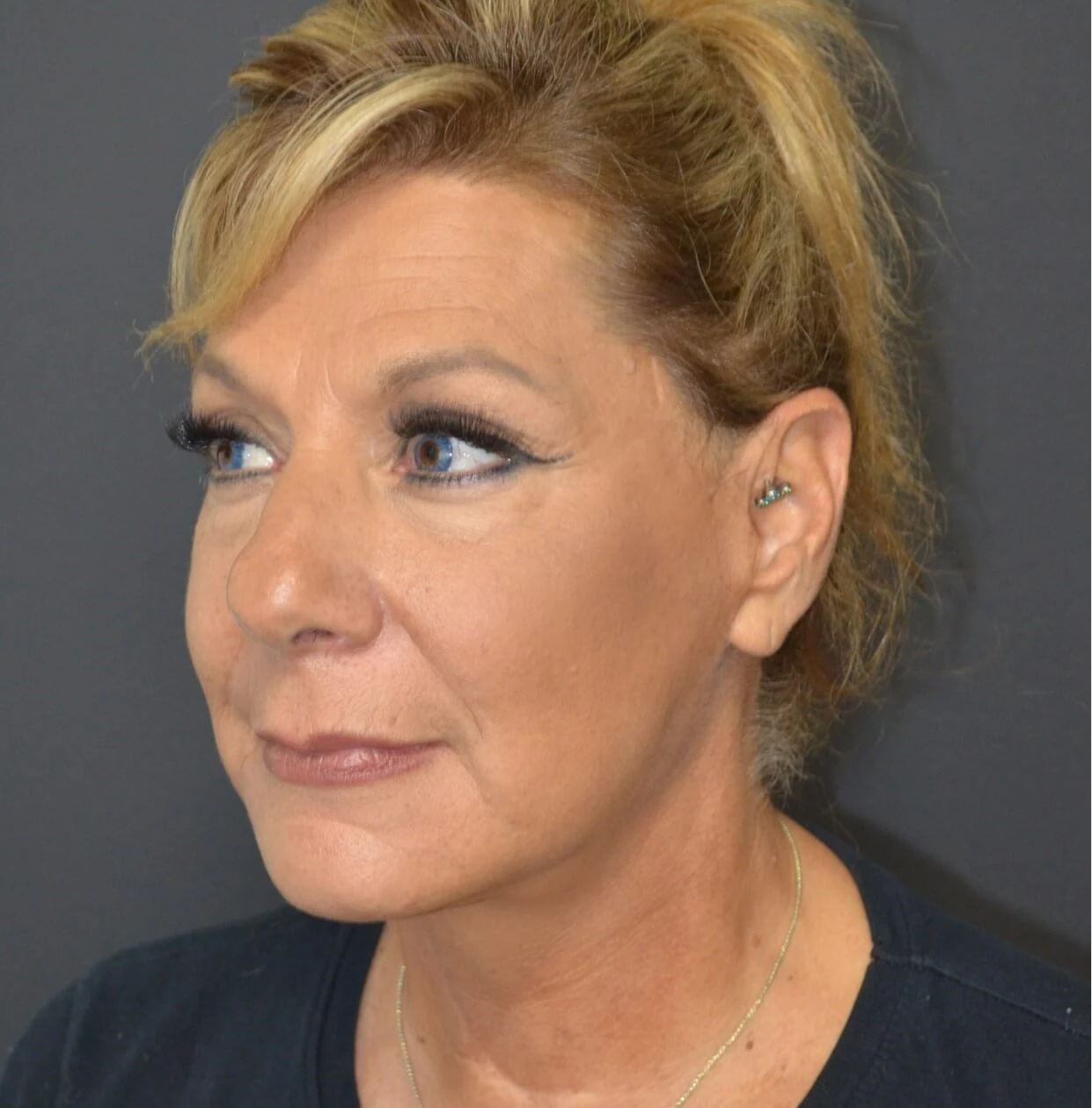 Deep plane facelift after — case 8, Austin TX