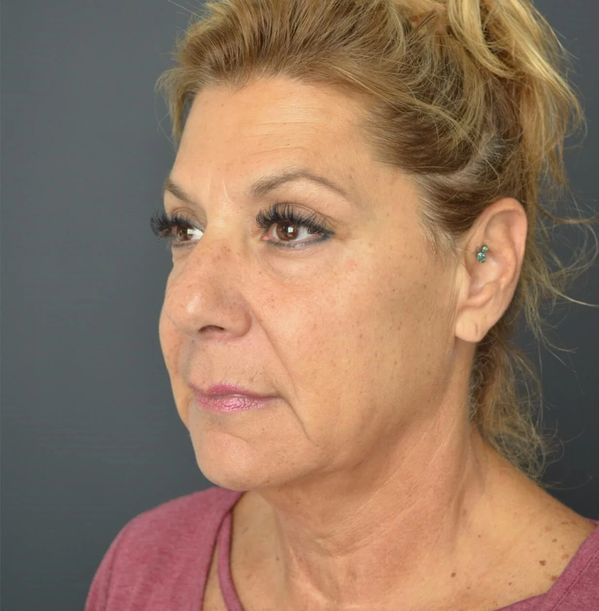 Deep plane facelift before — case 8, Austin TX