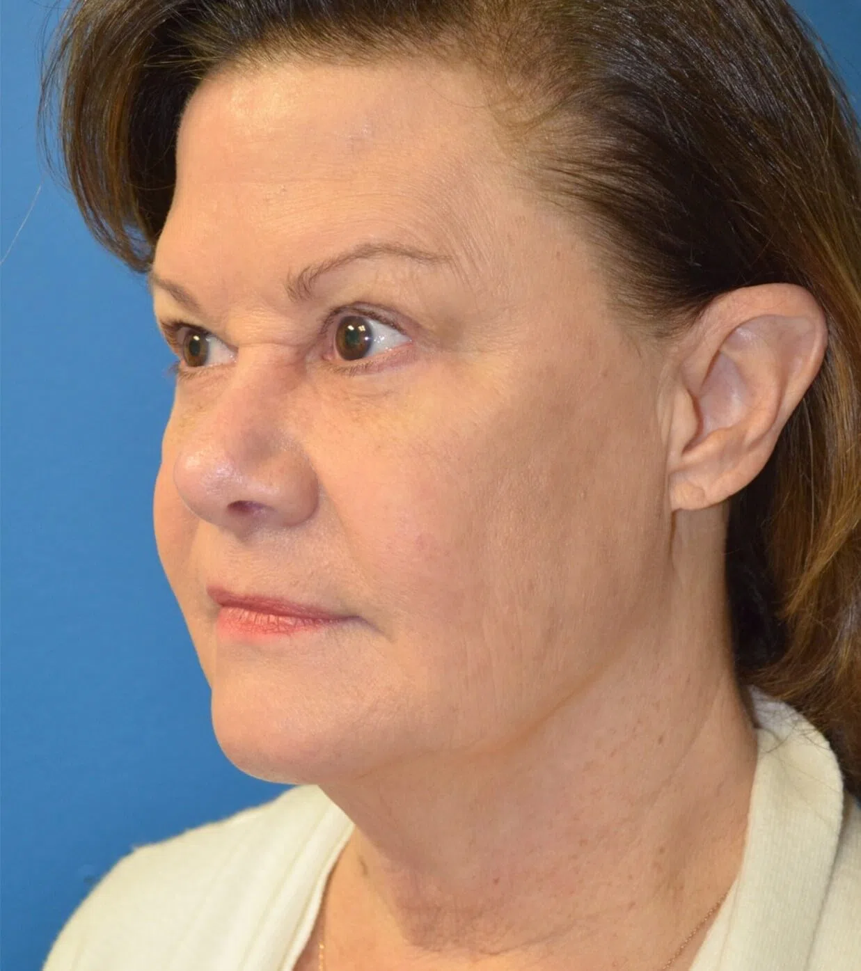 Deep plane facelift before — case 9, Austin TX