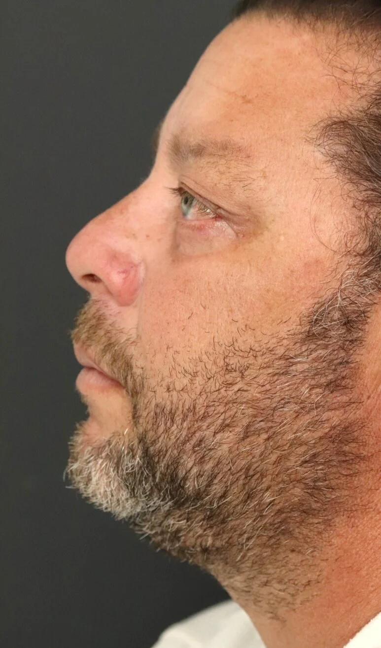 Eyelid lift blepharoplasty Austin TX