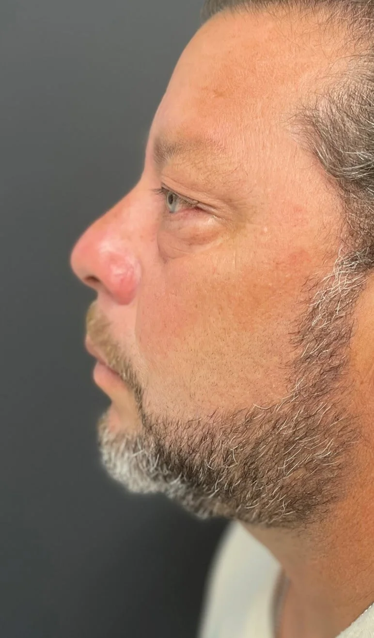 Eyelid lift blepharoplasty before — Austin TX patient