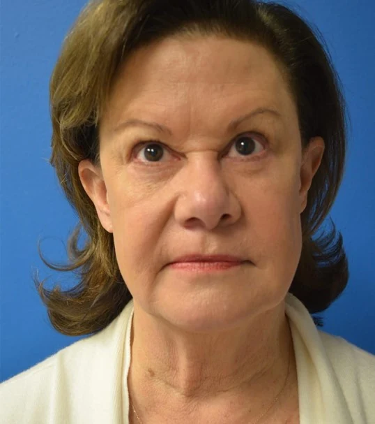Eyelid Lift before — case 10, Austin TX