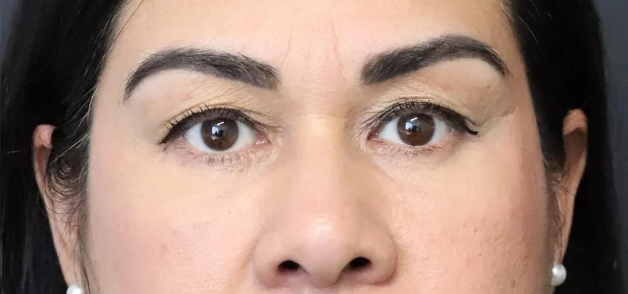 Eyelid Lift after — case 2, Austin TX