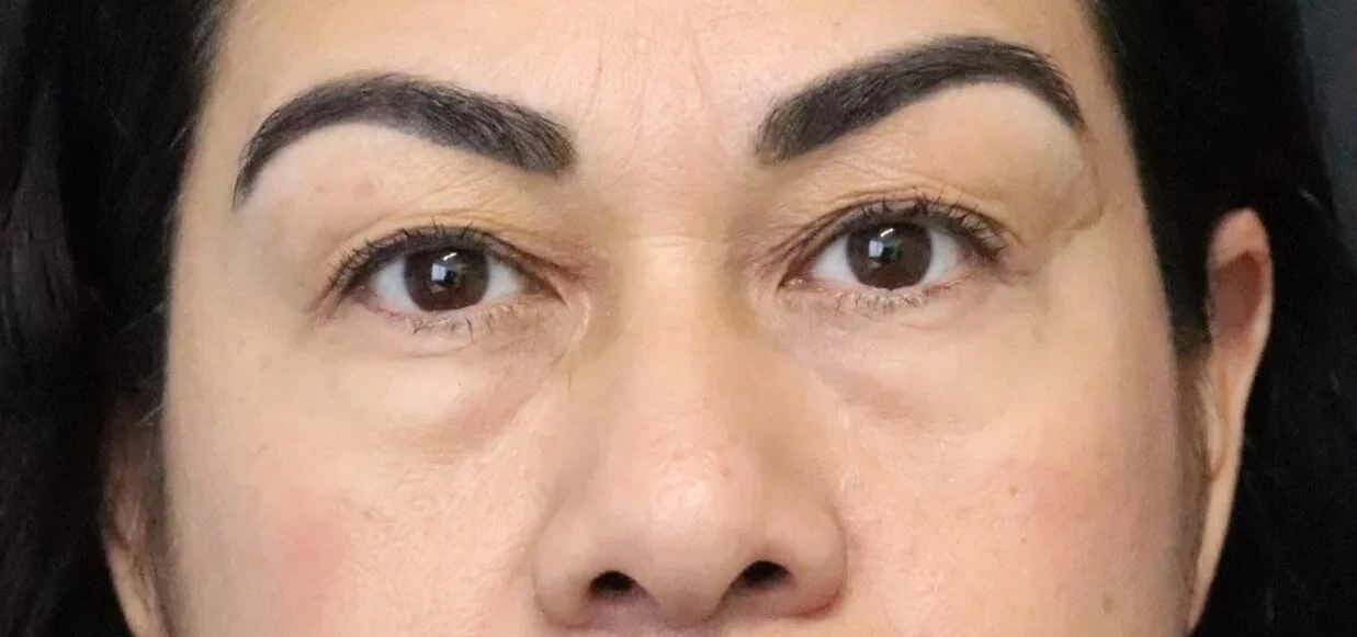 Eyelid Lift before — case 2, Austin TX