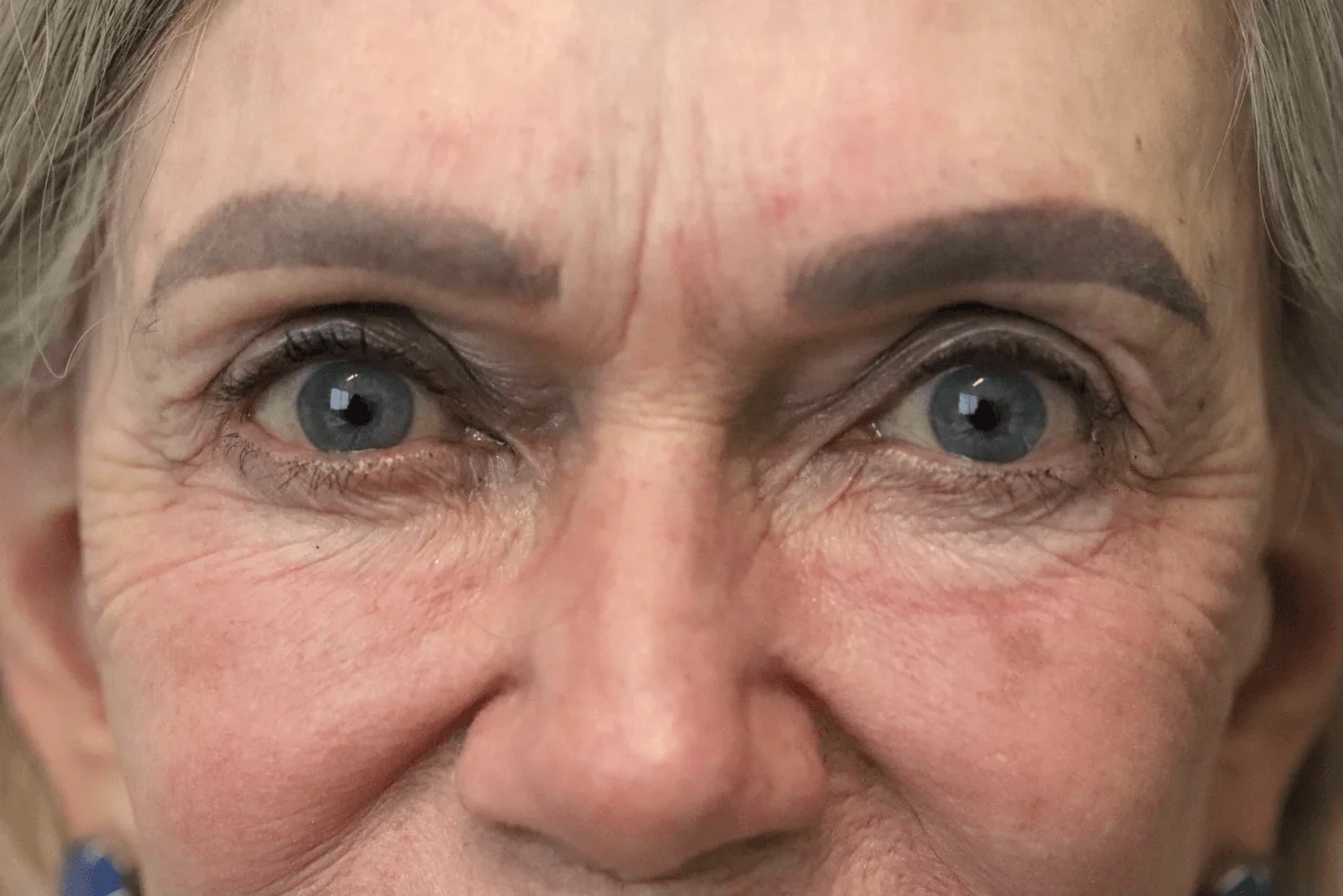 Eyelid Lift after — case 3, Austin TX