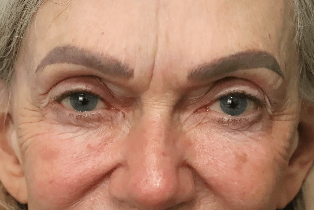 Eyelid Lift before — case 3, Austin TX