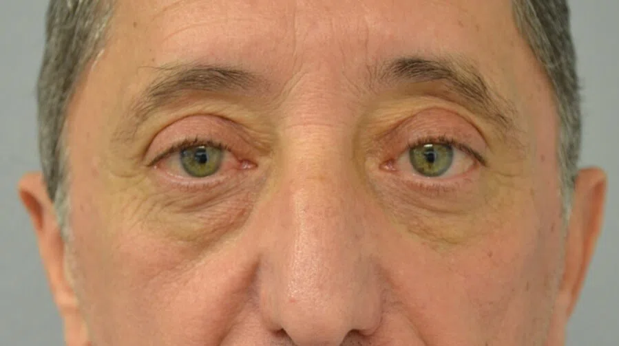 Eyelid Lift after — case 4, Austin TX