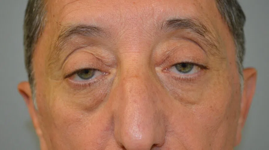 Eyelid Lift before — case 4, Austin TX