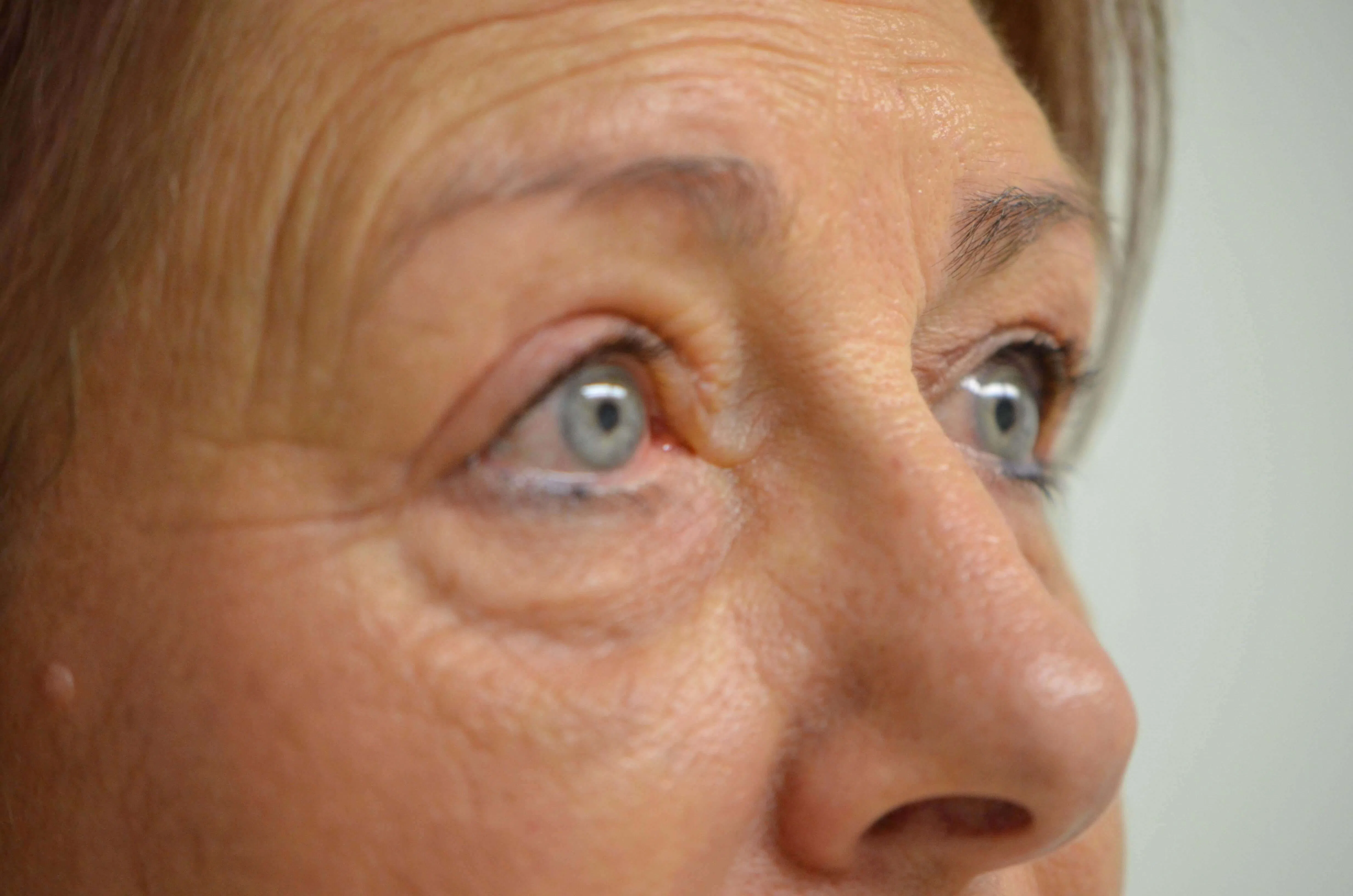 Eyelid Lift after — case 5, Austin TX