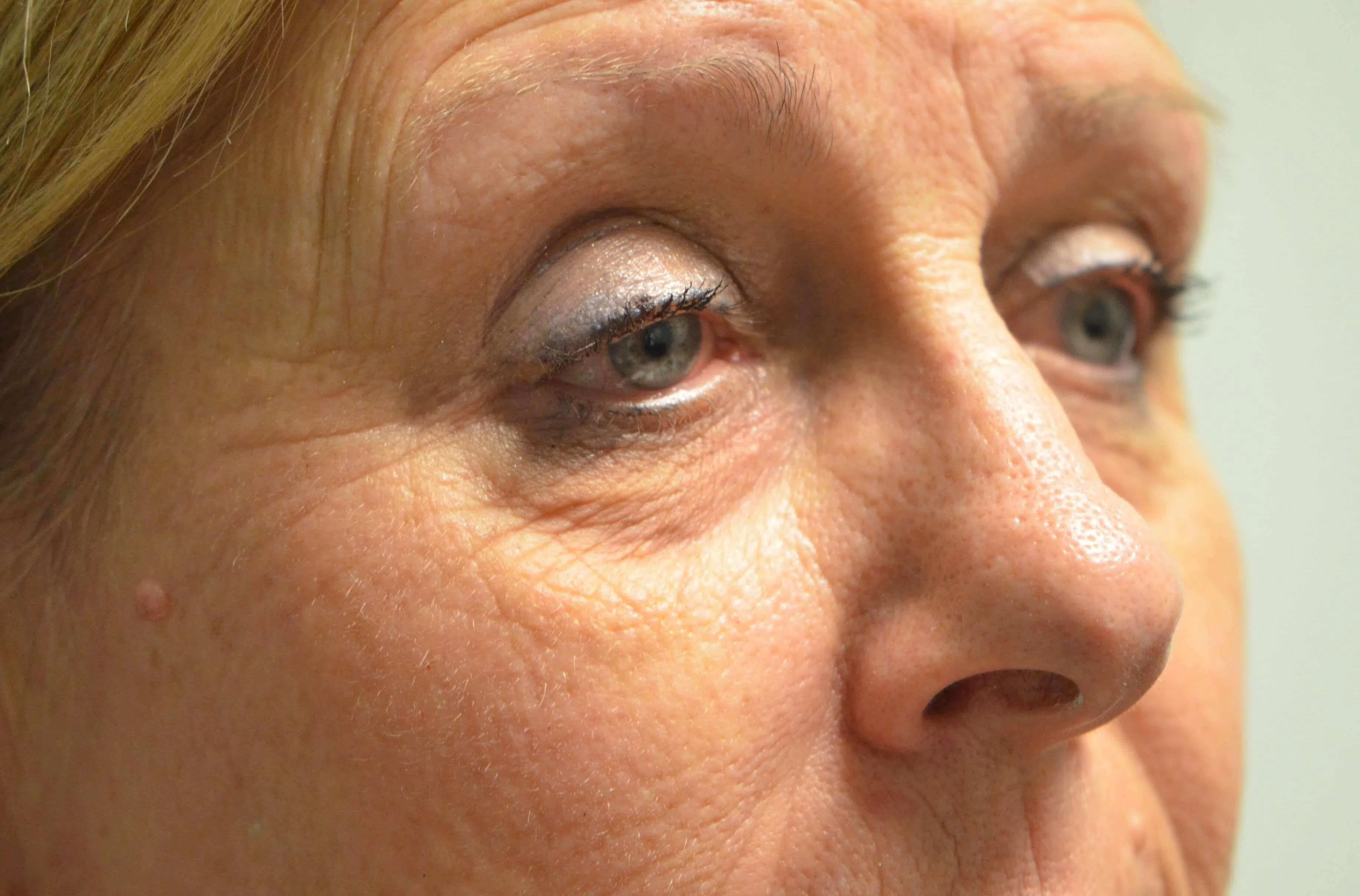 Eyelid Lift before — case 5, Austin TX