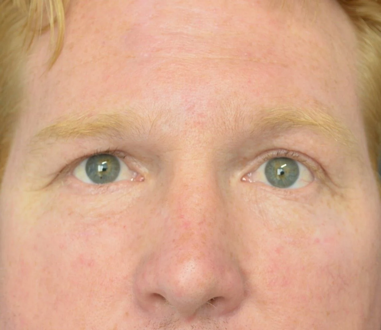 Eyelid Lift after — case 6, Austin TX