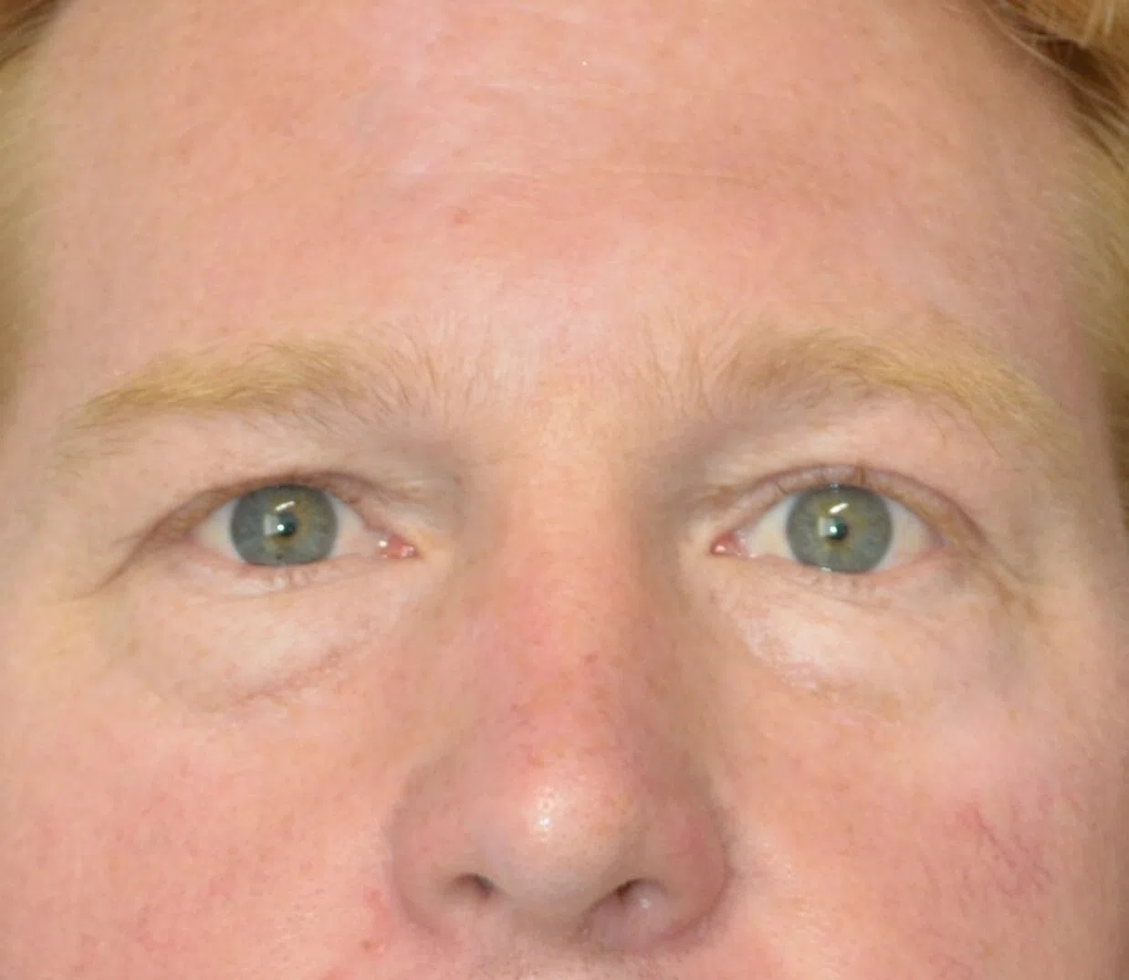 Eyelid Lift before — case 6, Austin TX