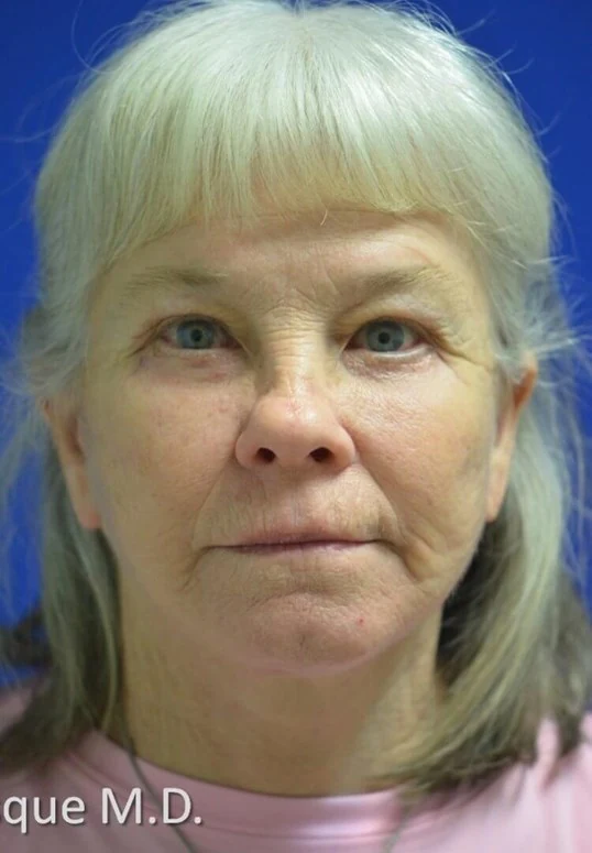 Eyelid Lift after — case 7, Austin TX