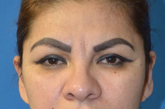 Eyelid Lift after — case 8, Austin TX