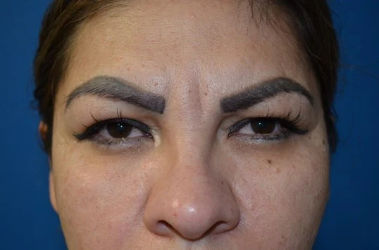 Eyelid Lift before — case 8, Austin TX