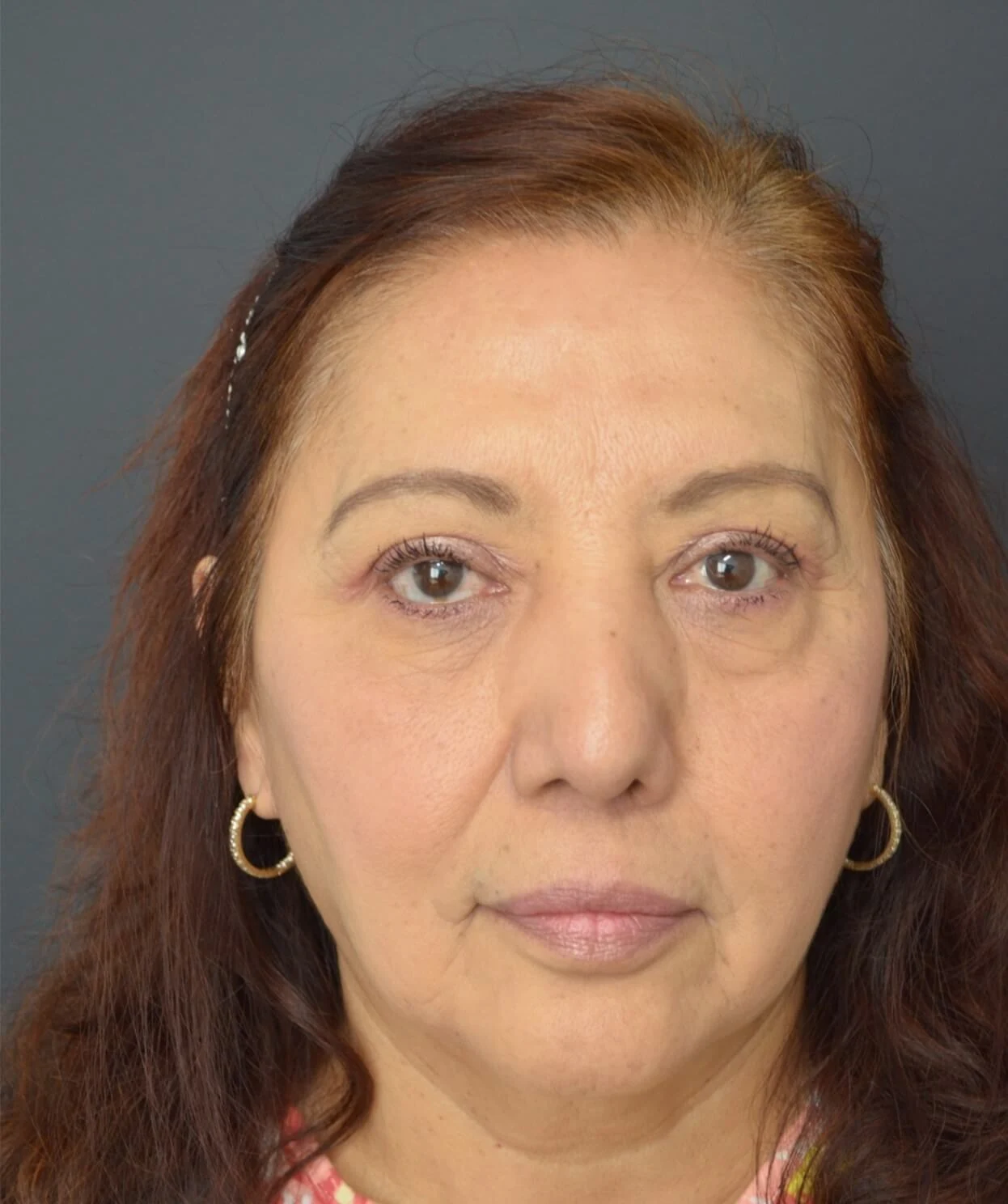 Eyelid Lift after — case 9, Austin TX