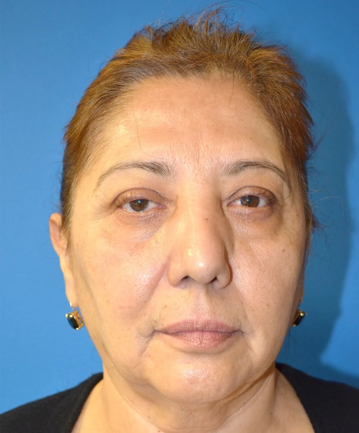 Eyelid Lift before — case 9, Austin TX
