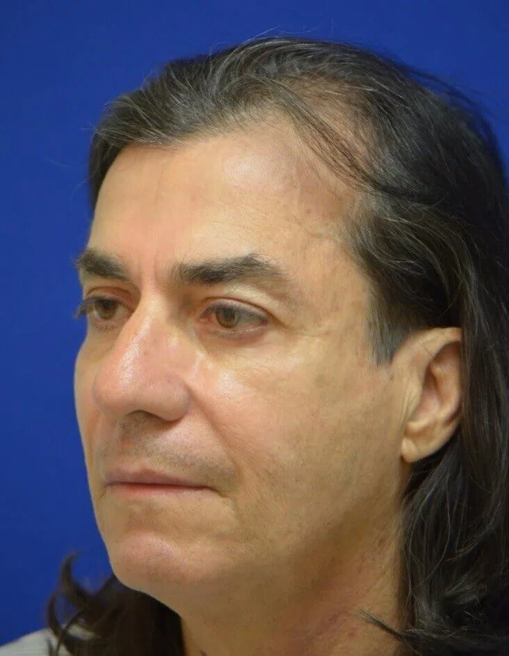 Facial Fat Grafting after — case 1, Austin TX
