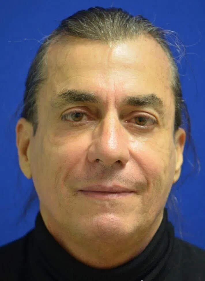Facial fat grafting before — Austin TX patient frontal
