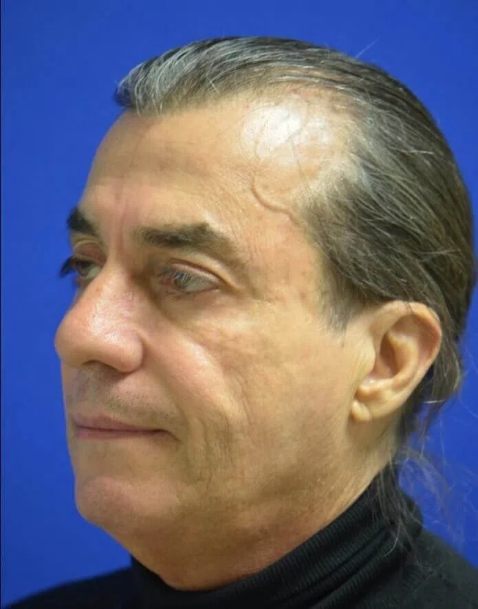 Facial Fat Grafting before — case 1, Austin TX