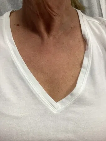 Clearer chest décolletage after Lumecca IPL