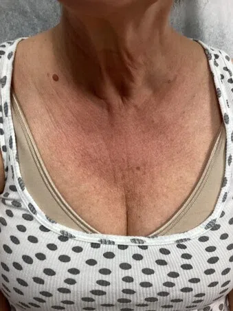 Chest décolletage with sun damage before Lumecca IPL