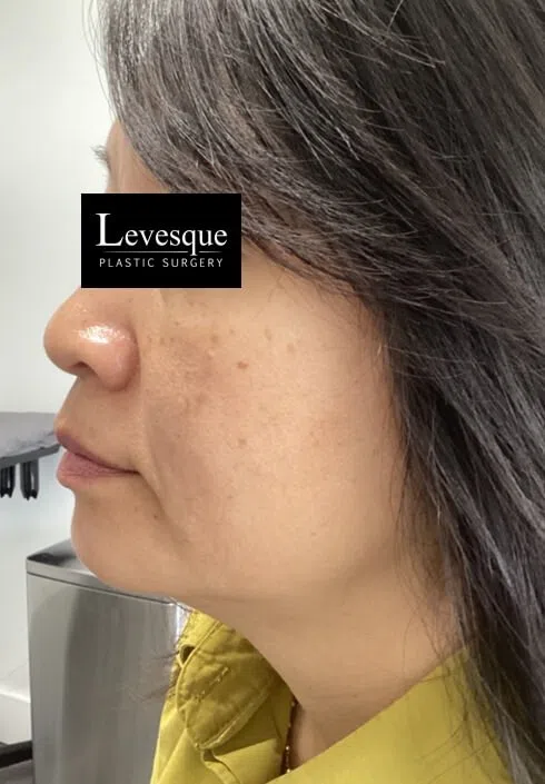Brighter, more even skin after Lumecca IPL