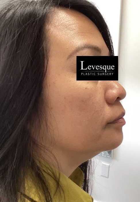 Clearer, even-toned cheek after Lumecca IPL