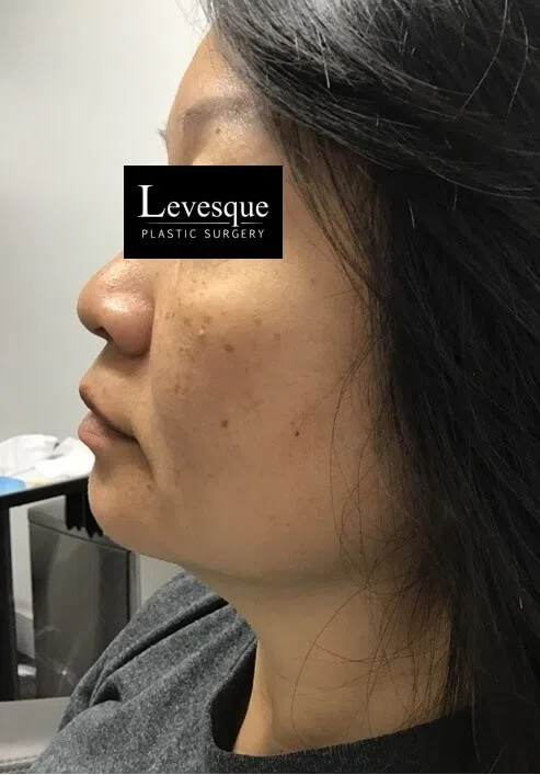 Other cheek with pigmentation before Lumecca IPL