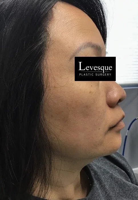 Cheek with sun damage and brown spots before Lumecca IPL