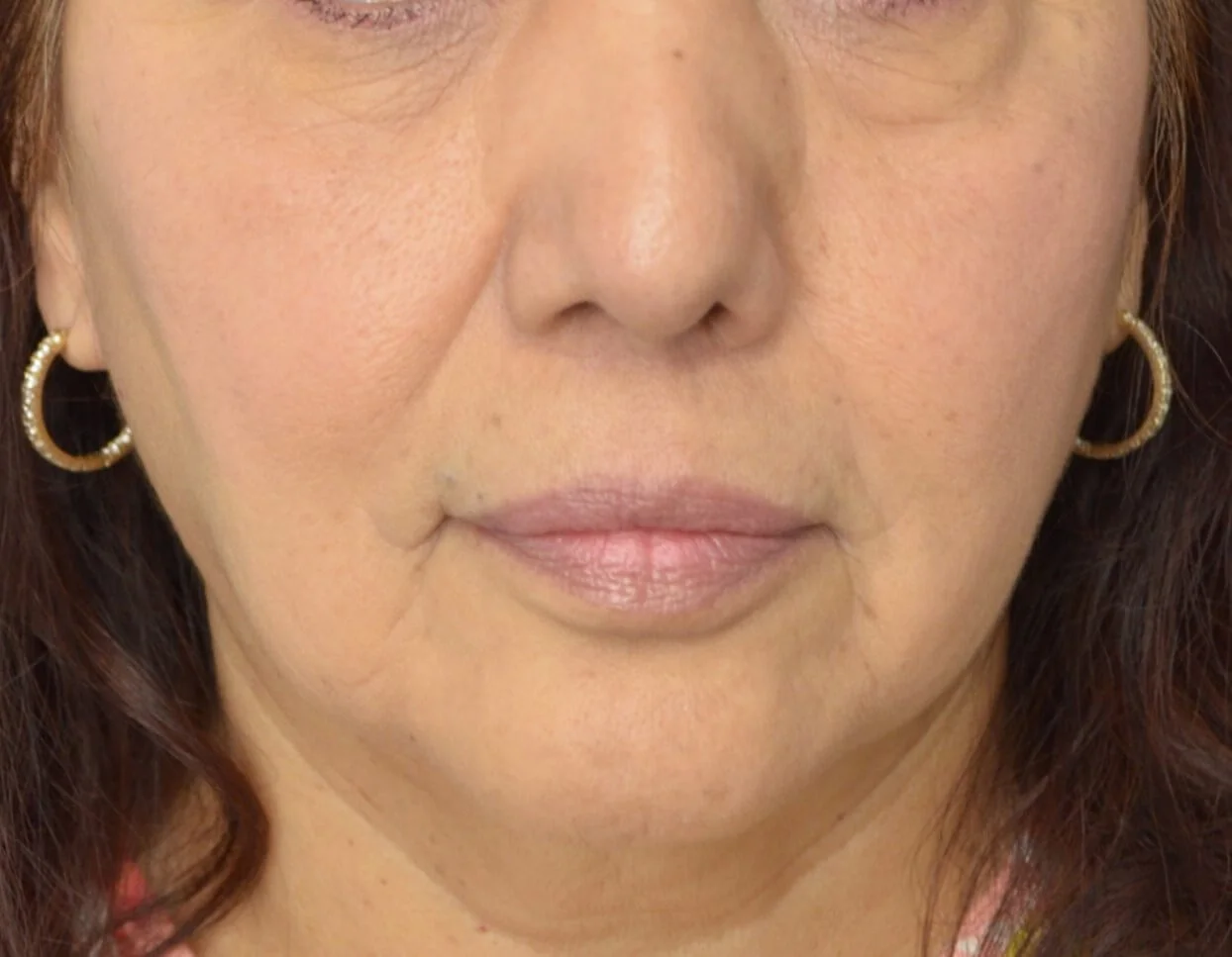 Lip Lift after — case 1, Austin TX