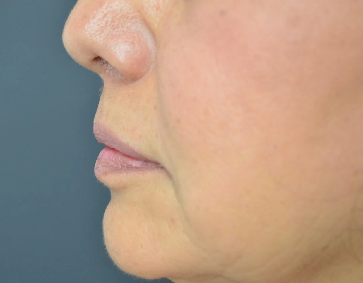 Lip lift after — Austin TX patient