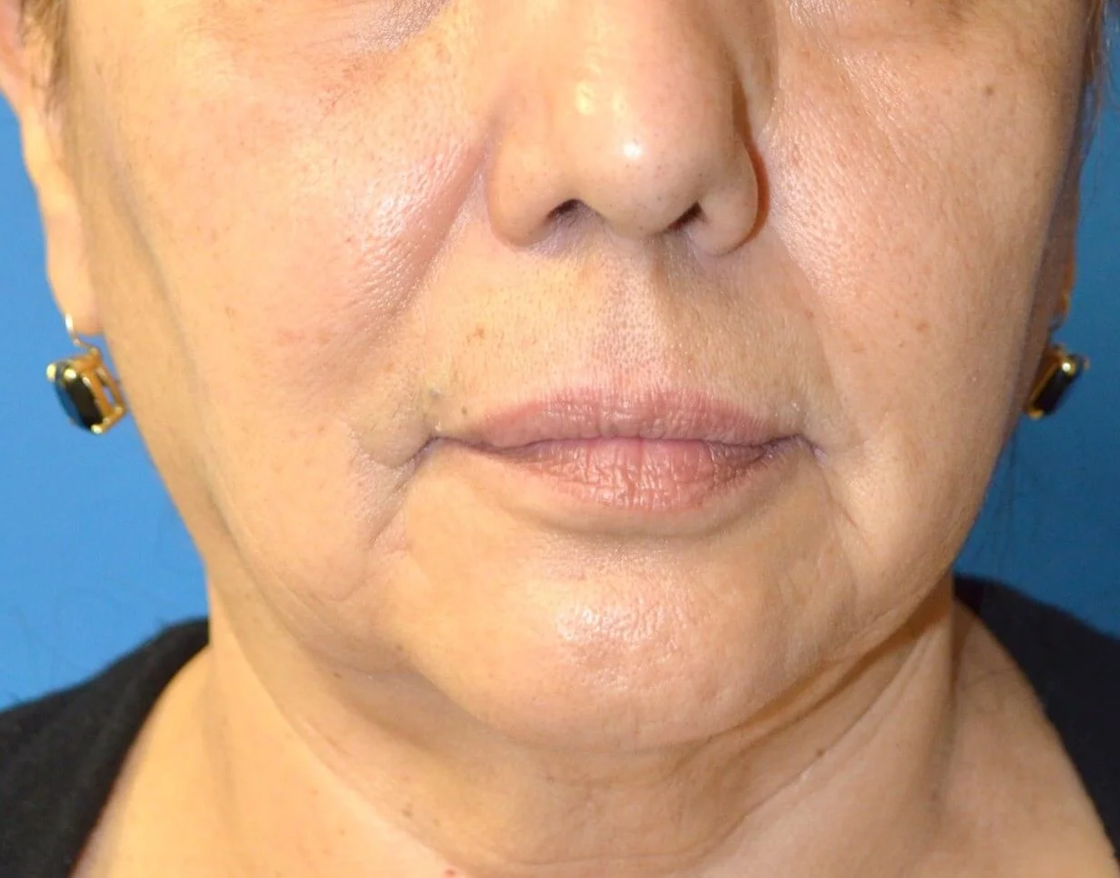 Lip Lift before — case 1, Austin TX